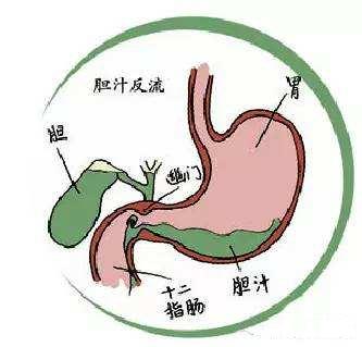 胆汁反流性胃炎严不严重？难不难治？为啥总